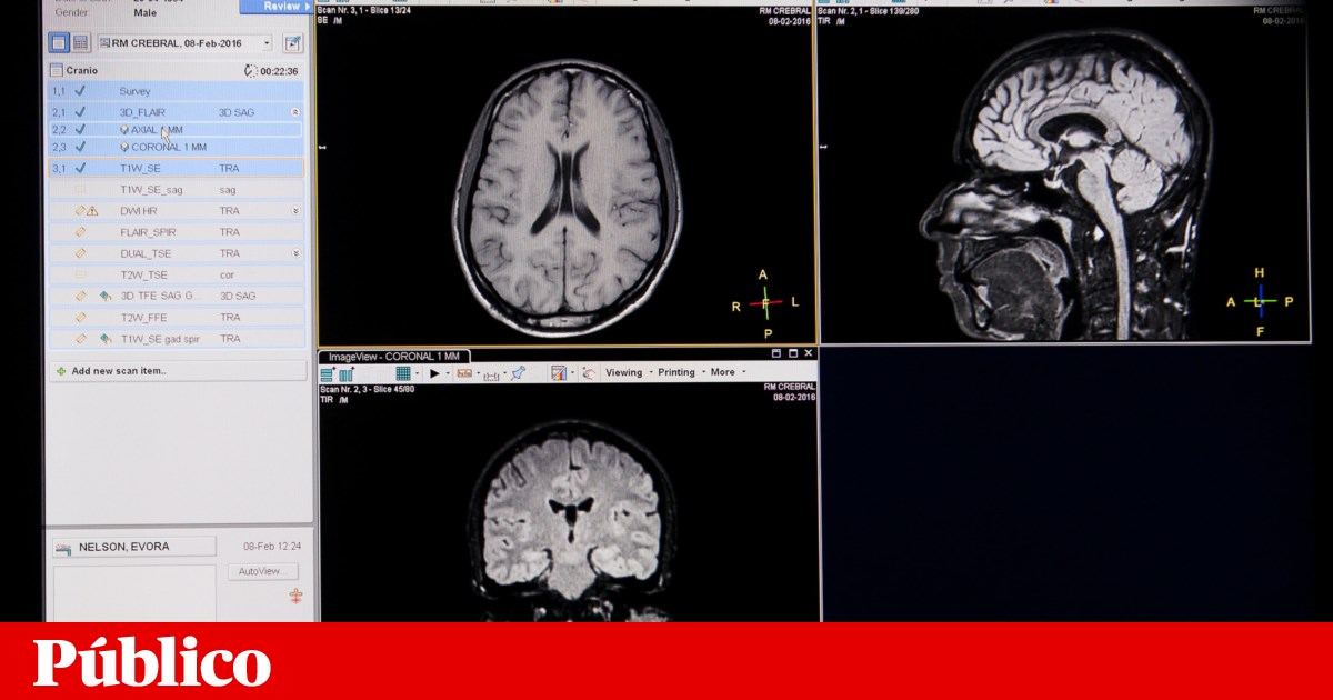 Estudo com mão portuguesa cria mapa cerebral de risco para doenças psiquiátricas