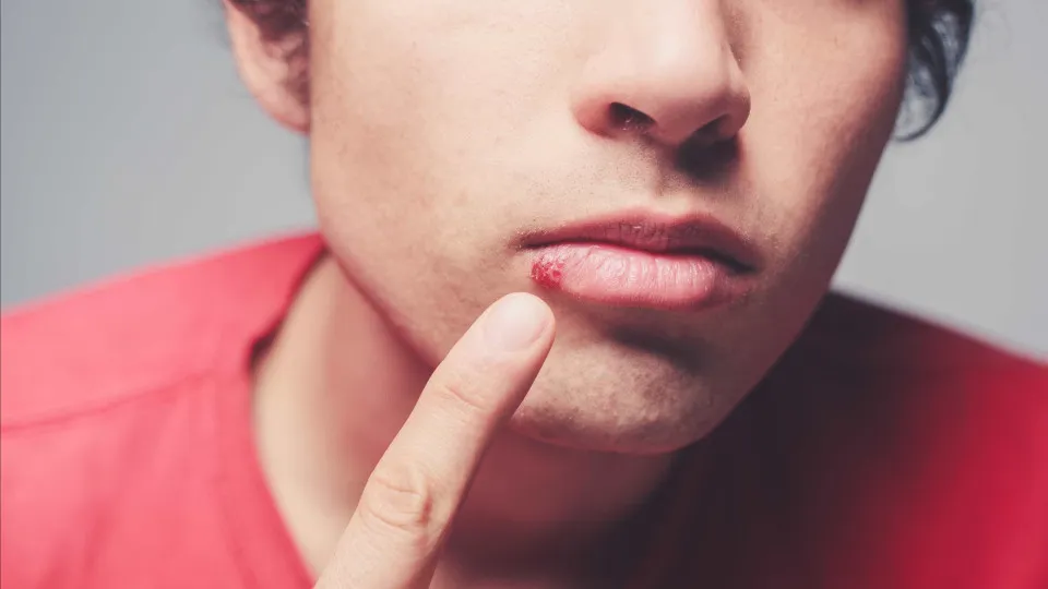 Se tem herpes, atenção! Infarmed suspendeu lotes de dois medicamentos
